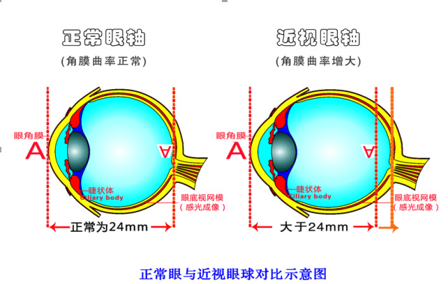 近视眼是指看远不清,看近清晰近视眼则由于眼的屈光系统与正常人不同